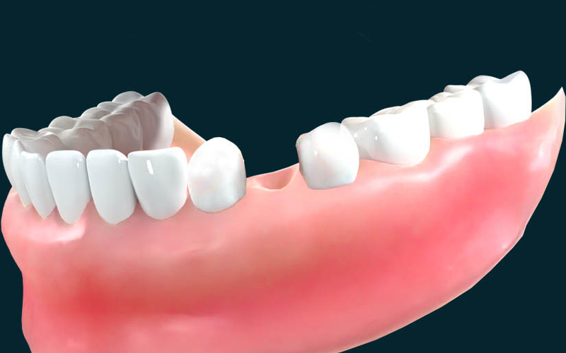After An Extraction: Why & When to Replace Missing Teeth